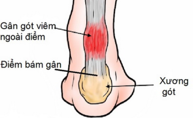 Viêm gân Achilles