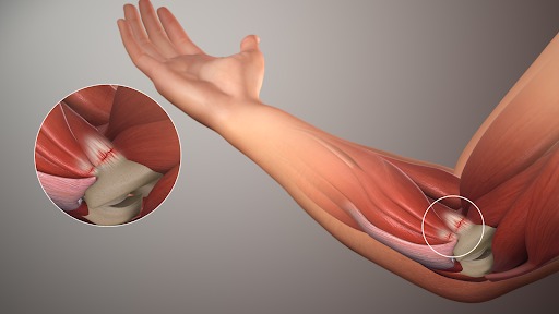 đánh cầu lông bị đau bắp tay