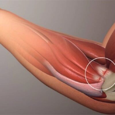 đau khuỷu tay khi đánh cầu lông