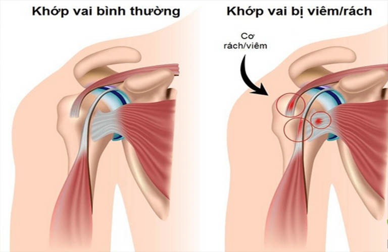 Các dạng tổn thương vai thường gặp và biểu hiện cụ thể